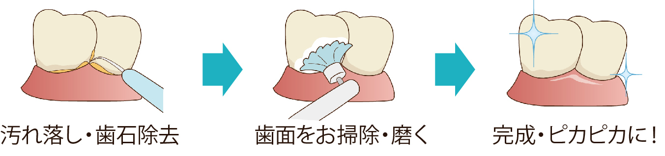 歯のクリーニング 歯のクリーニング