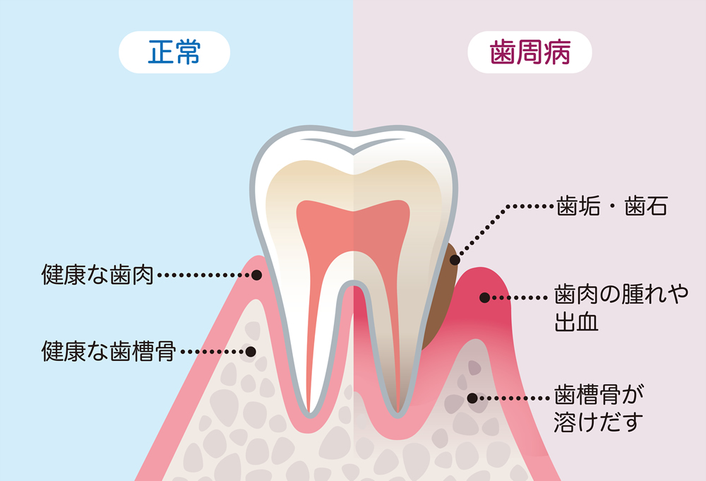歯周病の進行 歯周病の進行